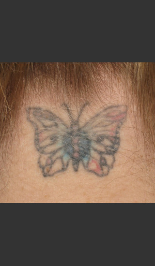 Before Photo for Treatment of Neck Tattoo - Roy G. Geronemus, M.D. - Prejuvenation