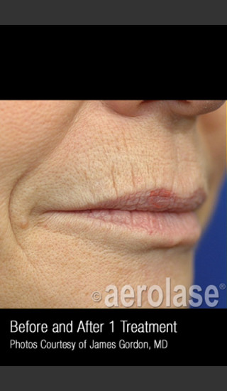 Before Photo for Treatment of Smoke Wrinkles #340 -  - Prejuvenation