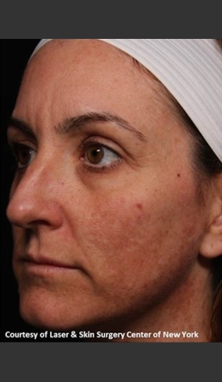 Before Photo for Full Face Rejuvenation with Fraxel Dual - Roy G. Geronemus, M.D. - Prejuvenation