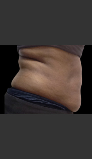 Before Photo for Body Contouring Treatment #120 -  - Prejuvenation