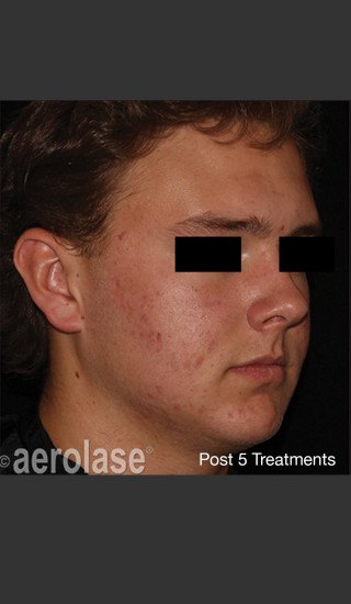 After Photo for NeoClear by Aerolase Acne Treatment - Amy Forman Taub, MD - Prejuvenation