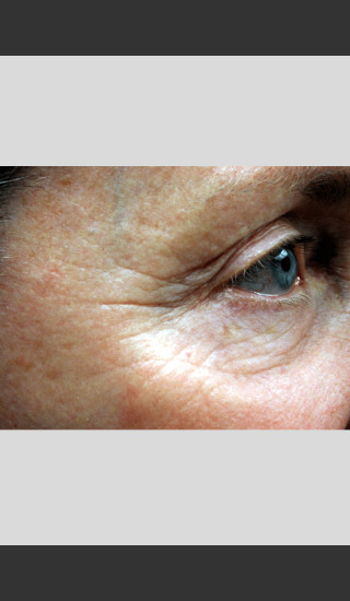 Before Photo for Vbeam Pulsed Dye Laser - Wrinkles -  - Prejuvenation