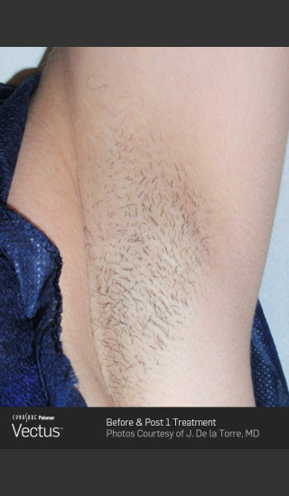 Before Photo for Hair Removal of Under Arms with Vectus -  - Prejuvenation