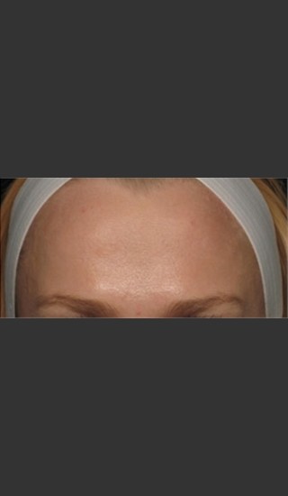 After Photo for Treatment of Forehead Wrinkles with Botox - Roy G. Geronemus, M.D. - Prejuvenation