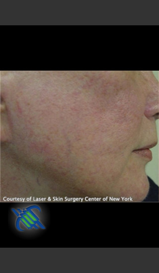 Before Photo for Facial Blood Vessels on Side of Face - Roy G. Geronemus, M.D. - Prejuvenation