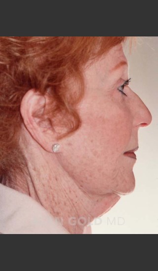 Before Photo for Rhytidectomy (Facelift) 161 Side View - Alan Gold MD - Prejuvenation
