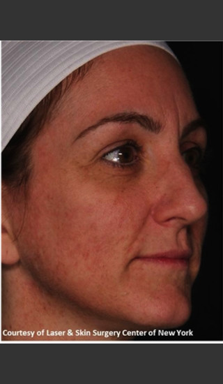 After Photo for Full face Treament with Fraxel - Roy G. Geronemus, M.D. - Prejuvenation
