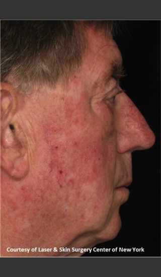 Before Photo for Full face Treament with Fraxel - Roy G. Geronemus, M.D. - Prejuvenation