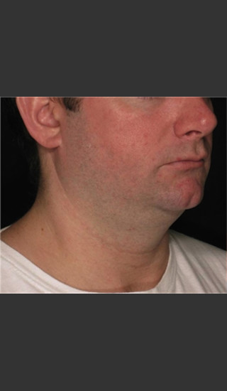 Before Photo for Treatment of Neck with Laser Liposuction -  - Prejuvenation