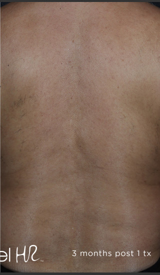 After Photo for Hair Removal of Full Back With Excel HR -  - Prejuvenation