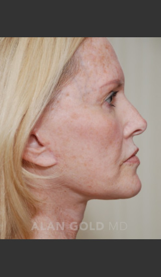 After Photo for Rhytidectomy (Facelift) 1753 Side View - Alan Gold MD - Prejuvenation