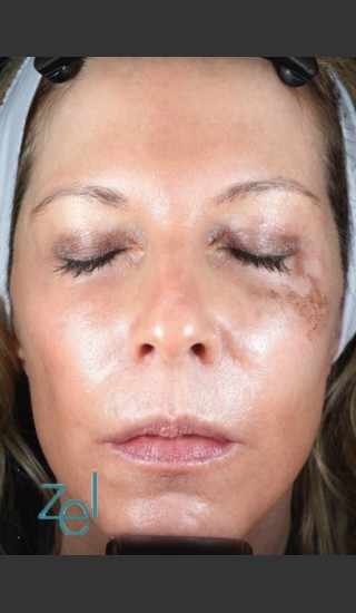 Before Photo for Treatment of Left Side Hyperpigmentation - Brian D. Zelickson, M.D. - Prejuvenation