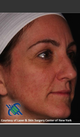 After Photo for Right Side Full Face Rejuvenation - Roy G. Geronemus, M.D. - Prejuvenation