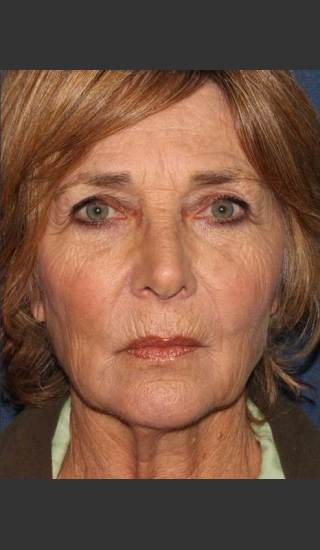 After Photo for Facial Volumization - Kimberly J. Butterwick M.D. - Prejuvenation