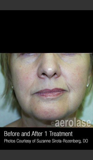 After Photo for Skin Tightening #342 -  - Prejuvenation