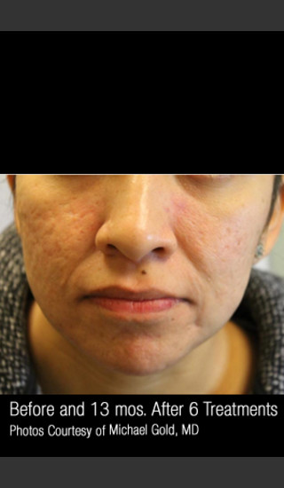 After Photo for Treatment of Cystic Acne #300 -  - Prejuvenation