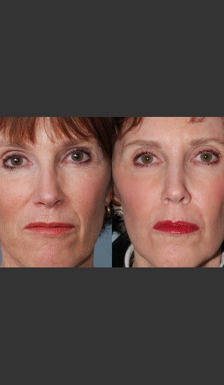 Before Photo for Single treatment of fully ablative  Laser Resurfacing - Mark B. Taylor, M.D. - Prejuvenation