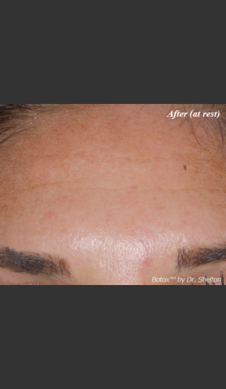 After Photo for Treatment of Forehead Creases with Botox - Ron M. Shelton, M.D. - Prejuvenation