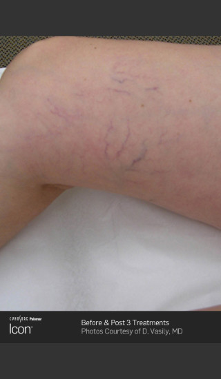 Before Photo for Leg Vein Clearance of Upper Thighs Using Icon -  - Prejuvenation