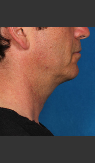 After Photo for Kybella Treatment 47 Year Old Male -  - Prejuvenation