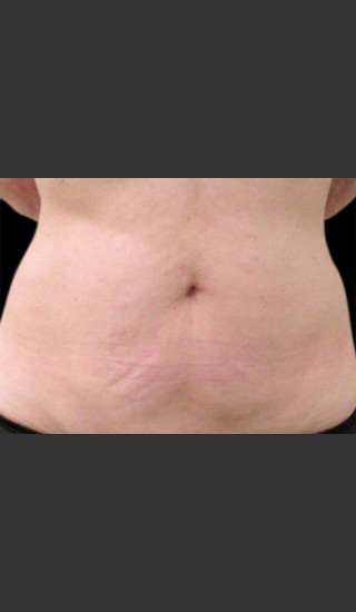 After Photo for Body Contouring Treatment #114 -  - Prejuvenation