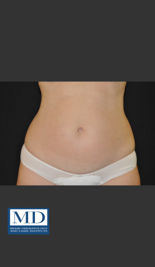 Before Photo for  Body Contouring Treatment 142 - Jill S. Waibel, MD - Prejuvenation