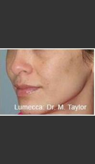 After Photo for Lumecca Intense Pulsed Light  #1 -  - Prejuvenation