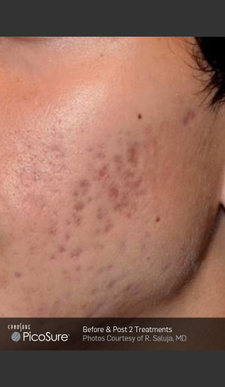 Before Photo for Acne Scar Treatment with Picosure -  - Prejuvenation