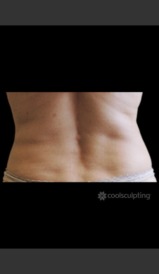 After Photo for CoolSculpting Before & After on Woman -  - Prejuvenation