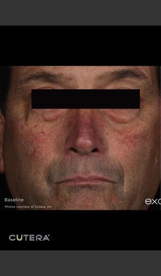 Before Photo for Periorbital Vein Before & After Photo -  - Prejuvenation