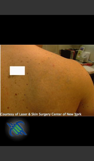 After Photo for Treatment of Shoulder Tattoo - Roy G. Geronemus, M.D. - Prejuvenation