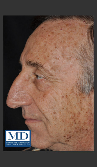 Before Photo for Brown Spots on Face Treatment 121 - Jill S. Waibel, MD - Prejuvenation
