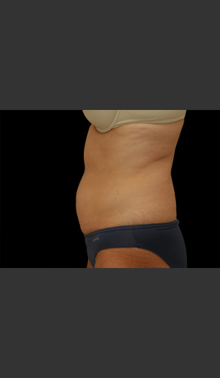 Before Photo for Body Contouring Treatment #110 -  - Prejuvenation