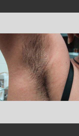 Before Photo for Treatment of Underarms with Gentle Laser -  - Prejuvenation