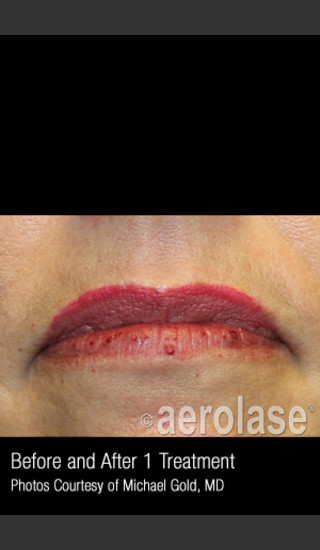 Before Photo for Treatment of Facial Blood Vessels #337 -  - Prejuvenation