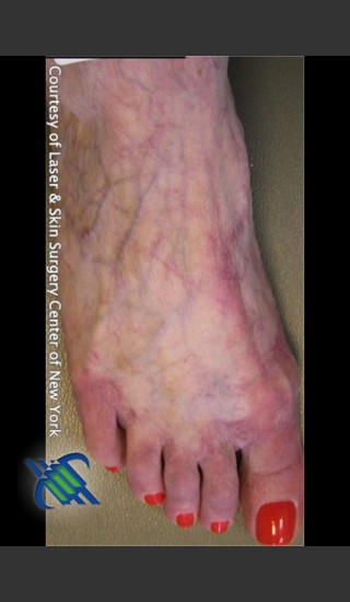 After Photo for Treatment of Foot Leg Veins - Roy G. Geronemus, M.D. - Prejuvenation