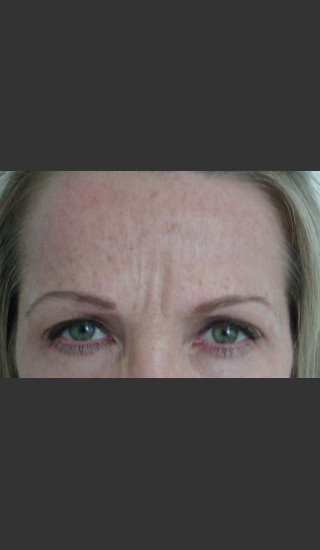 Before Photo for Serene Procedure (Nuebelle) - James Newman - Prejuvenation