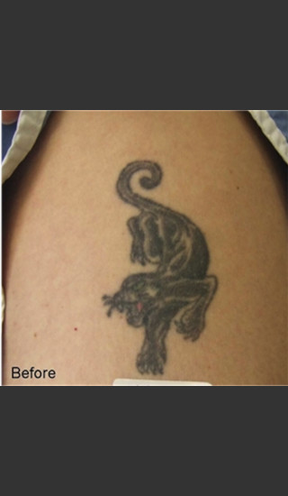 Before Photo for Treatment of Tattoo -  - Prejuvenation