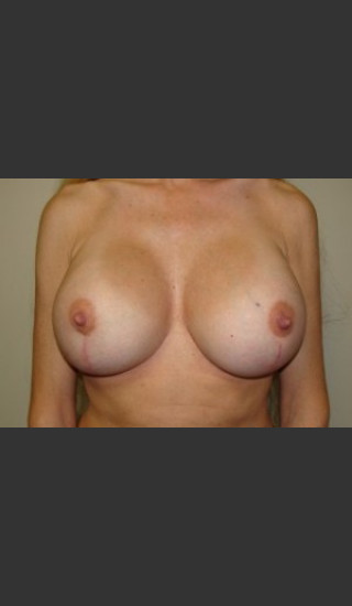 After Photo for Breast Revision 5654 - Sanjay Grover MD FACS - Prejuvenation