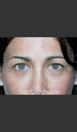 Before Photo for Blepharoplasty - Patient 2 - Steven Fagien, MD - Prejuvenation