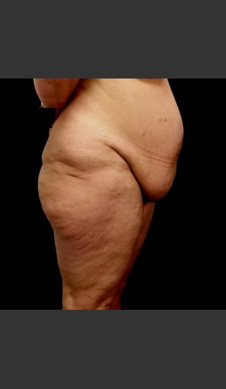 Before Photo for Circumferential Body Lift Case #1 - Gallaher Plastic Surgery & Spa MD - Prejuvenation