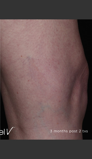 After Photo for Leg Vein Clearance Using Excel V -  - Prejuvenation