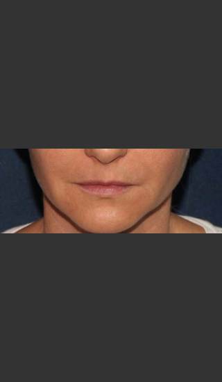 Before Photo for Lip Augmentation - Mitchel P. Goldman M.D. - Prejuvenation