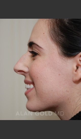 Before Photo for Rhinoplasty 1669 Side View - Alan Gold MD - Prejuvenation