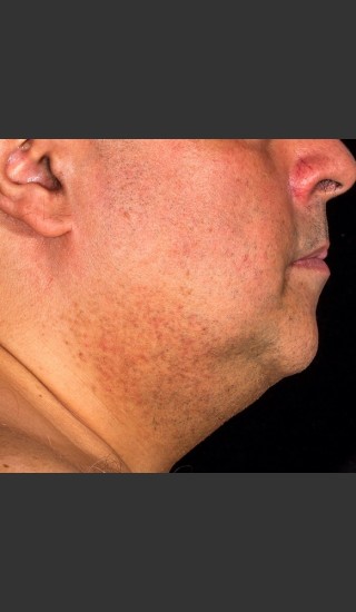 After Photo for SculpSure Submental - Lawrence Bass MD - Prejuvenation