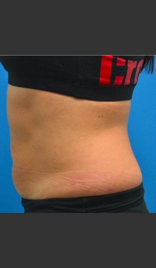 After Photo for SculpSure Abdomen -  - Prejuvenation