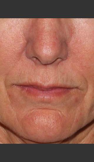Before Photo for Reduction of Perioral Lines - Douglas Wu, M.D. - Prejuvenation