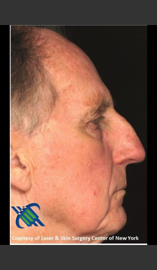 After Photo for Full Face Treatment with Fraxel Right Side  - Roy G. Geronemus, M.D. - Prejuvenation