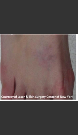 After Photo for Treatment of Foot Tattoo -  - Prejuvenation