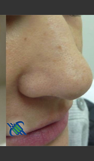 After Photo for Treatment of Nose Acne Scar - Roy G. Geronemus, M.D. - Prejuvenation